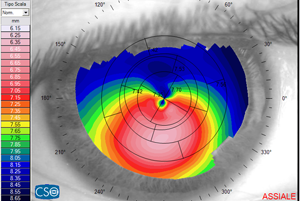 Topografia corneale